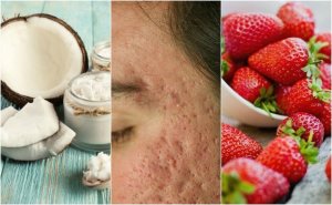 5 hemmagjorda behandlingar för att reducera ärr från akne