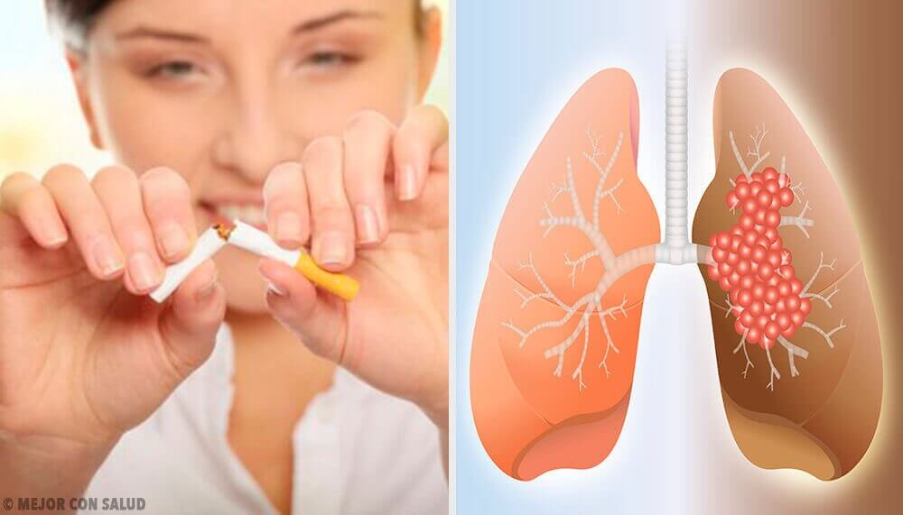 Orsaker till lungcancer och relaterad diagnos