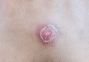 Vad är furunklar? 7 sätt att bli av med dem