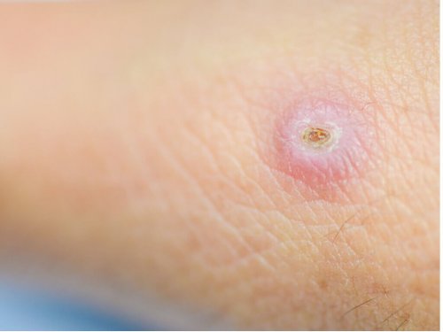 Varför bildas furunklar?