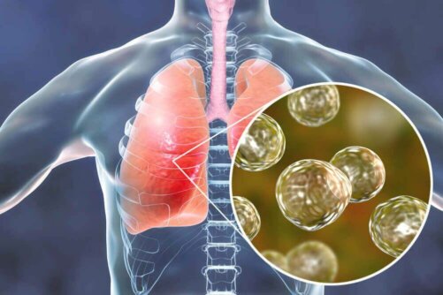 5 naturliga botemedel mot symptom på blastomykos