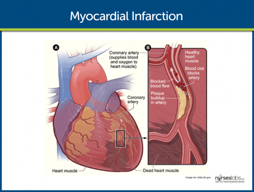 Ett hjärta med hjärtinfarkt