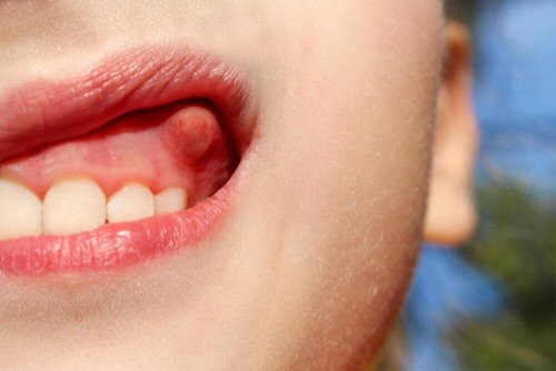 10 huskurer för att behandla en tandböld