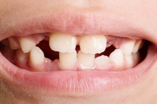 Hypodonti – avsaknad av en eller flera tänder