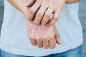 Fem effektiva och lokala örtkurer för psoriasis