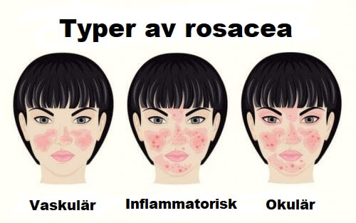 Typer av rosacea