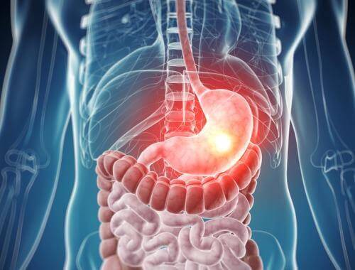 Dessa är de vanligaste livsmedelsintoleranserna