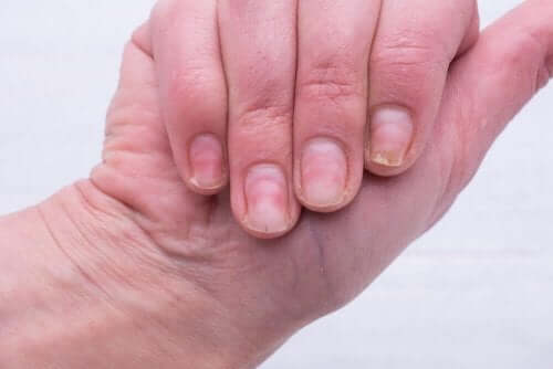 varför får man gula naglar
