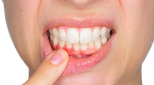 Information om att behandla tandbölder