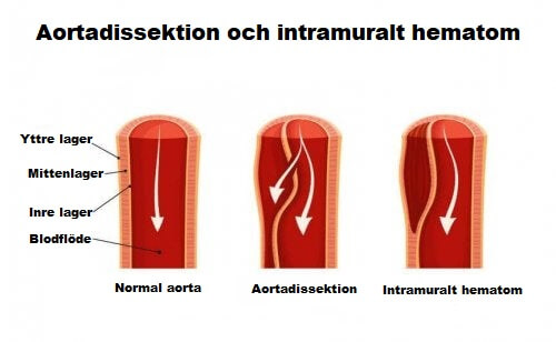 Fakta om aortadissektion