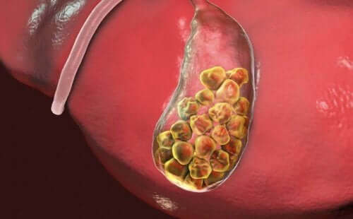 Hur gallstenar bildas