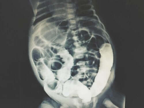 Röntgen av peritoneum