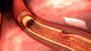 Fakta om aortadissektion: vad orsakar det?