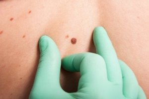 ABCDE-testet för hudcancer – vad är det?
