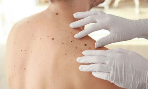 ABCDE-testet för hudcancer