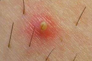 Tips för att förebygga inåtväxande hårstrån