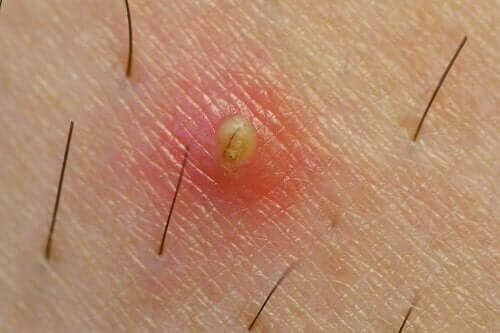 Tips för att förebygga inåtväxande hårstrån