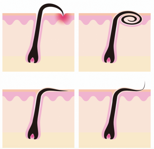 Hårstrån och hårsäckar