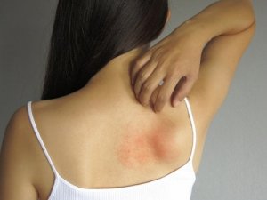 5 lokala kurer för att lindra hudutslag