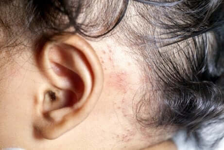 Psoriasis i skalpen