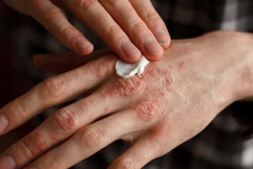Skydda huden: vanor för psoriasis