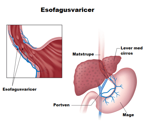 Tecken och symptom på esofagusvaricer
