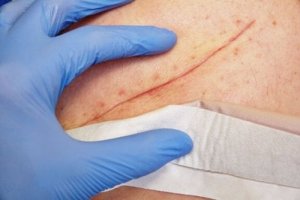 Grundläggande tekniker för att stänga sår