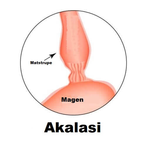 Diagram av matstrupen