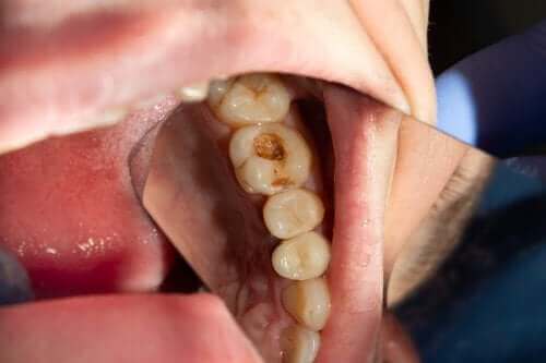 Vad orsakar karies och hål i tänderna?