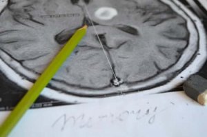 Förebyggande av och symptom på amnesi