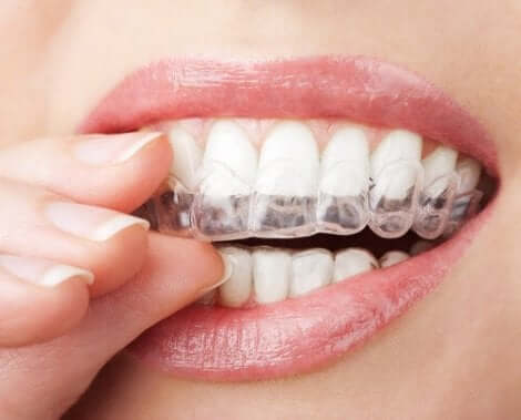 Genomskinlig tandskena