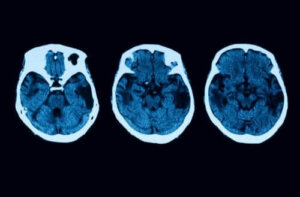 Diagnos och behandling av posterior kortikal atrofi
