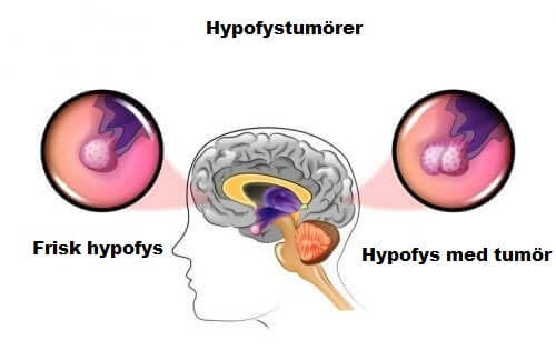 Orsaker till och symptom på hypofystumörer