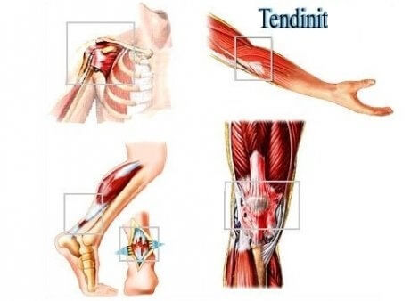 Tendinit i musklerna