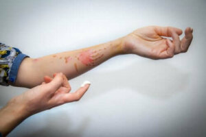 Hur man behandlar en ytlig brännskada