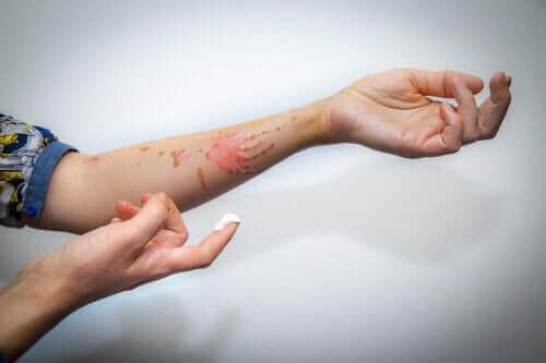 Hur man behandlar en ytlig brännskada