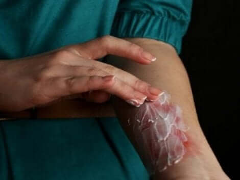 Salva för ytlig brännskada