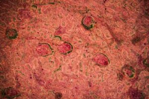 Diagnos njurtuberkulos: symptom och behandling