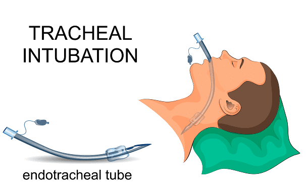 Illustration av hur intubation går till.