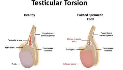 Orsaker till testikelvridning och vanliga symptom