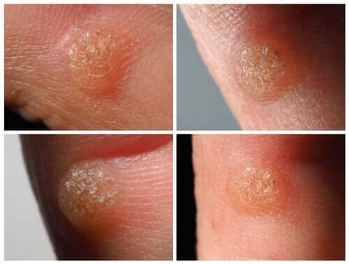 Vårta på finger.