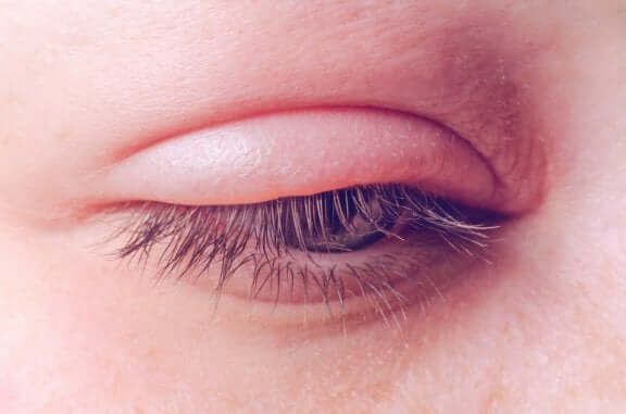 Inflammation i ögonlocken - orsaker och behandling