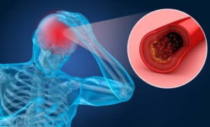 Riskfaktorer och symptom på stroke