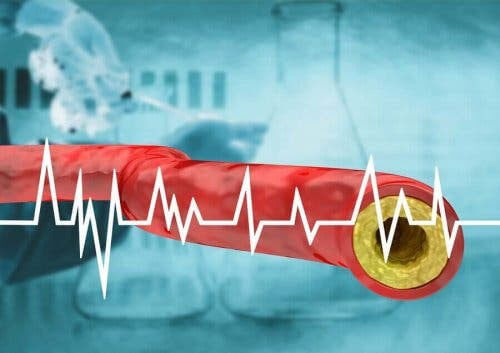 illustration av artär med åderförkalkning och kurva med hjärtrytm