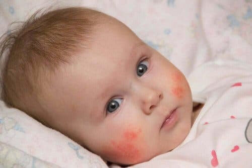 baby med atopisk dermatit