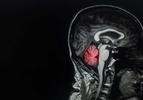 Metastaser i hjärnan - orsaker och behandling