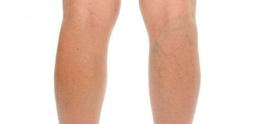 Ett par ben med åderbråck.