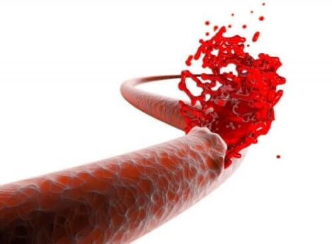 Riskerna för blödning efter operation