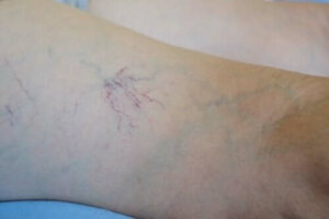 Läkemedlet venoruton - egenskaper och användning