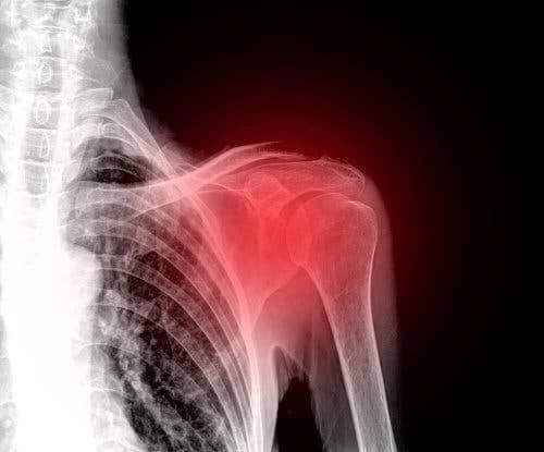 Röntgen av en skadad axel.